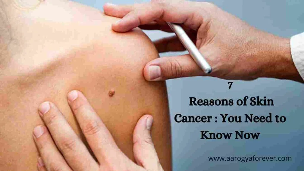 7 Reasons of Skin Cancer