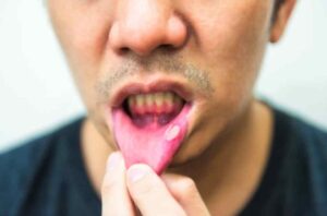 mouth Ulcer