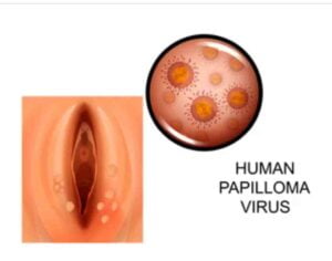 HPV virus & cancer